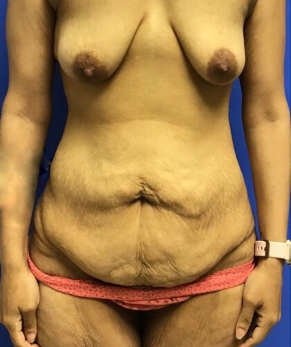 Tummy Tuck case #4011