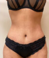 Tummy Tuck case #4011