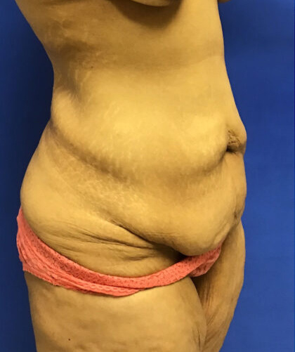 Tummy Tuck case #4011