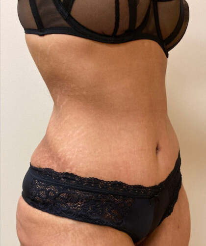 Tummy Tuck case #4011