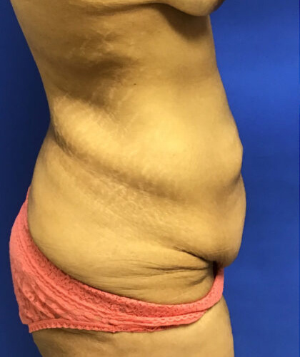 Tummy Tuck case #4011