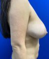 Fat Transfer to the Breasts - American Breast Lift™ ABL case #2474