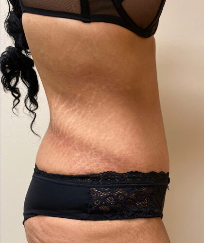 Tummy Tuck case #4011