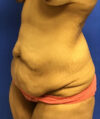 Tummy Tuck case #4011