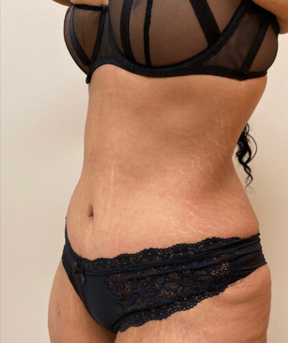 Tummy Tuck case #4011