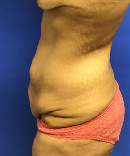Tummy Tuck case #4011