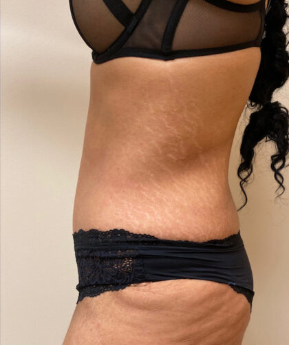 Tummy Tuck case #4011