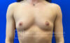 Breast Augmentation case #2758
