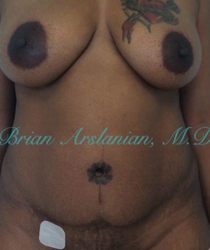 Liposuction case #3588