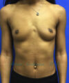 Breast Augmentation case #2519