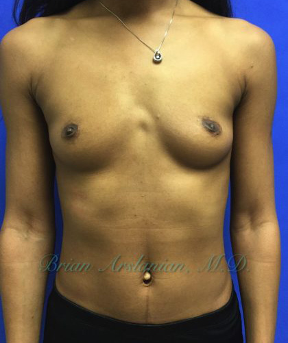 | Arslanian Plastic Surgery Atlanta Before & After Plastic Surgery Results | breast procedure