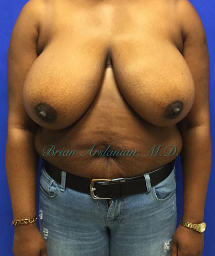 Breast Reduction case #2901