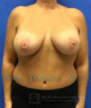 Breast Implants and Lift case #3002