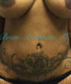 Liposuction case #3588