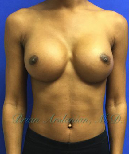 Breast Augmentation case #2519