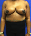 Breast Reduction case #2901