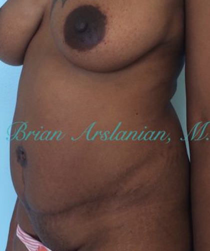 Liposuction case #3588
