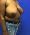 Breast Reduction case #2901