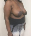 Breast Lift case #2840