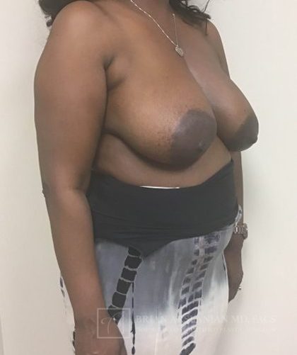 Breast Lift case #2840