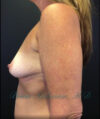 Breast Augmentation case #2556