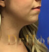 Neck Liposuction case #3842