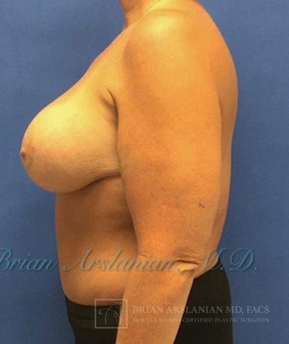 Breast Implants and Lift case #3002
