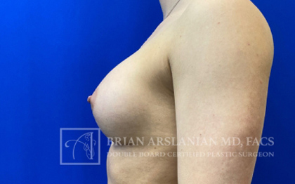 Breast Augmentation case #2758