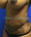 Liposuction case #3588