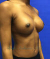 Breast Augmentation case #2519