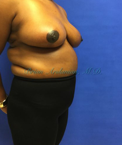 Breast Reduction case #2901