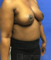 Breast Lift case #2840