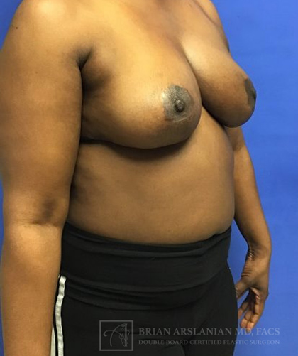 Breast Lift case #2840