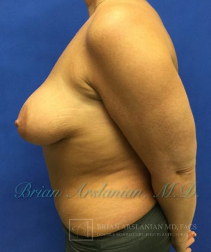 Breast Implants and Lift case #3002