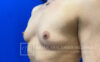 Breast Augmentation case #2758