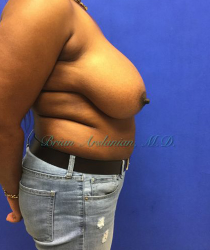 Breast Reduction case #2901