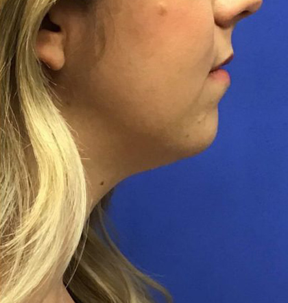 Neck Liposuction case #3842