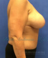 Breast Implants and Lift case #3002