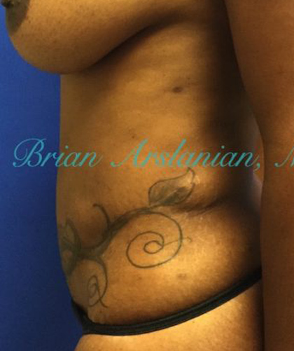 Liposuction case #3588