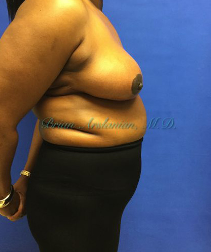 Breast Reduction case #2901