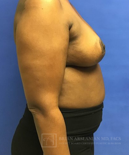 Breast Lift case #2840