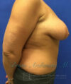 Breast Implants and Lift case #3002