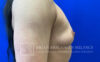 Breast Augmentation case #2758