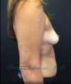 Breast Augmentation case #2556