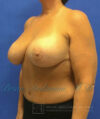 Breast Implants and Lift case #3002