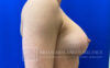 Breast Augmentation case #2758