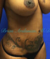 Liposuction case #3588