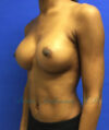 Breast Augmentation case #2519