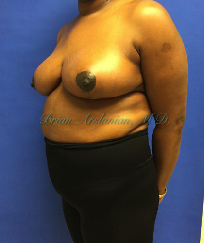 Breast Reduction case #2901