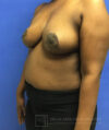 Breast Lift case #2840